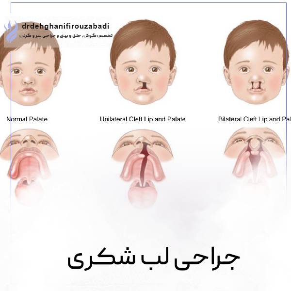 شکاف کام و لب