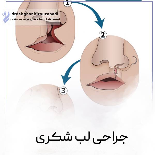 جراحی لب شکری