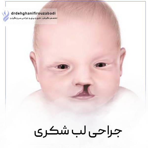 جراحی شکاف کام و لب