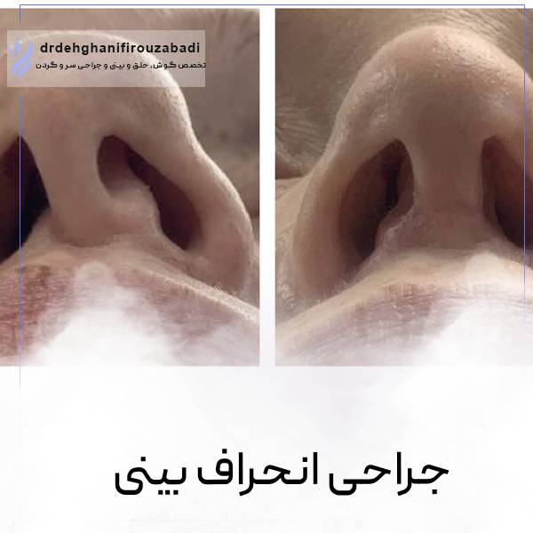 عمل انحراف بینی