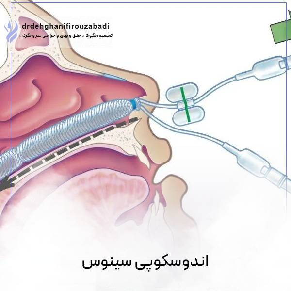 جراحی اندوسکوپی سینوس- دکتر امرالله دهقانی