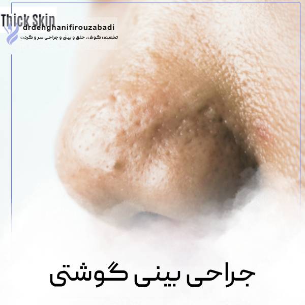 عکس عمل بینی گوشتی در یزد