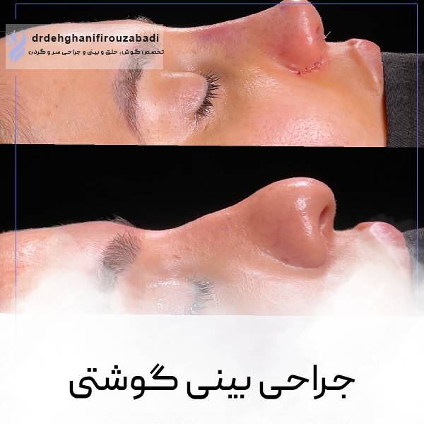 عکس جراحی بینی گوشتی در یزد | دکتر دهقانی فیروز آبادی