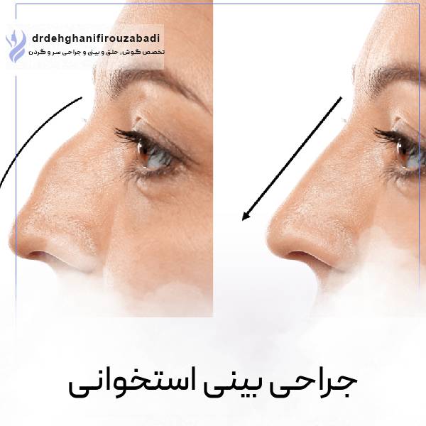 جراحی بینی استخوانی