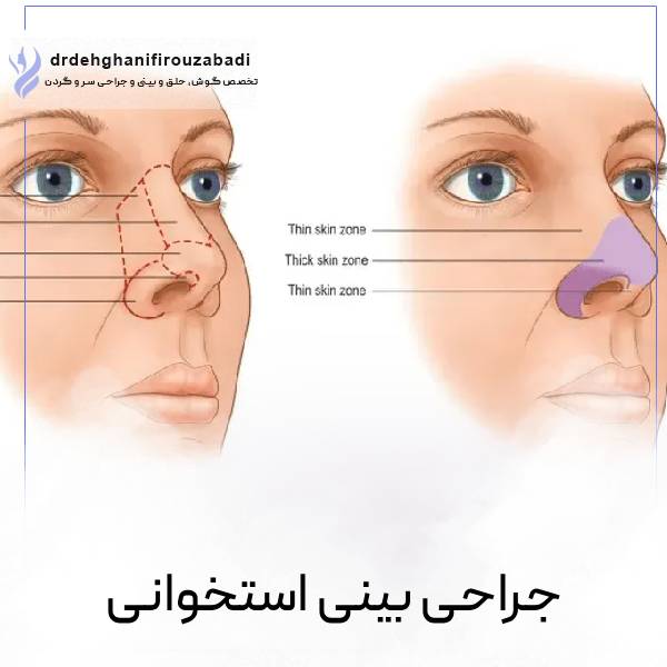 مل بینی استخوانی - دکتر امرالله دهقانی