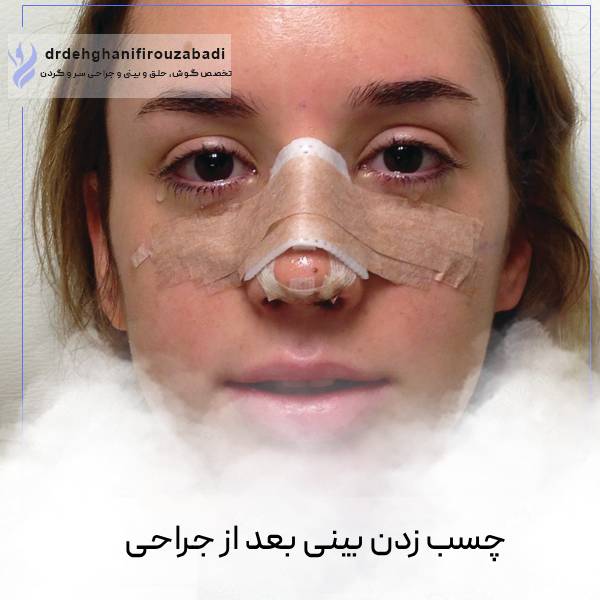 چسب زدن بینی بعد از جراحی
