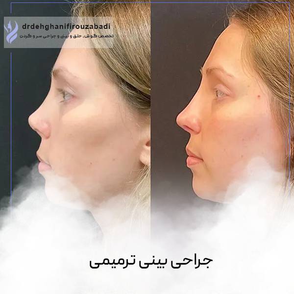 رینوپلاستی ترمیمی یا ثانویه