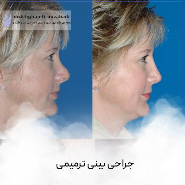 جراحی ترمیم بینی | دکتر امرالله دهقانی